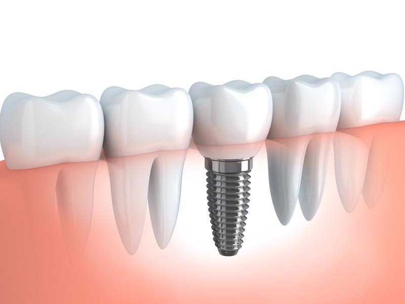 Dental Implants Winnsboro, LA