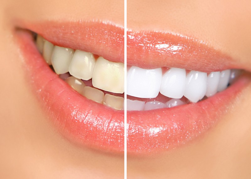 Teeth Whitening Winnsboro, LA