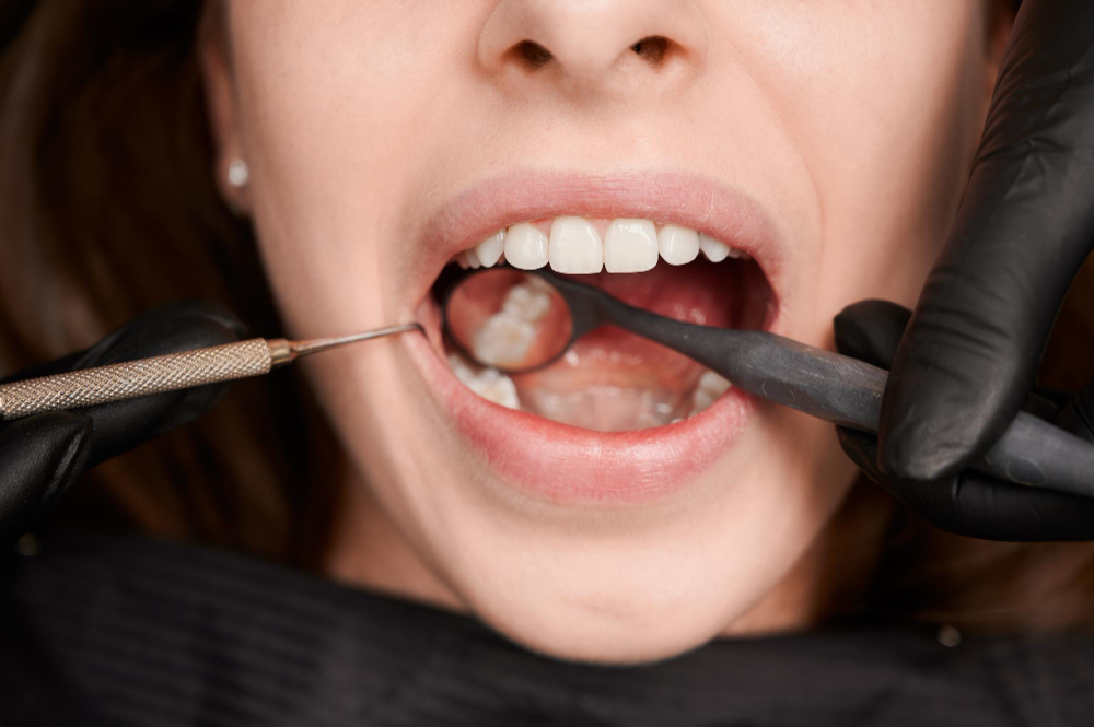 Dental Fillings (Composite/Tooth-Colored)
